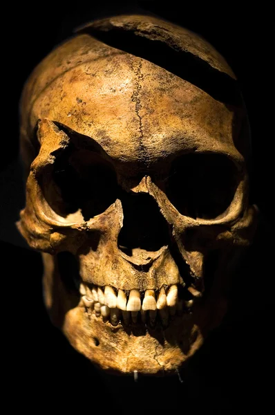 Human skull, boken forehead, cleaved by an axe.