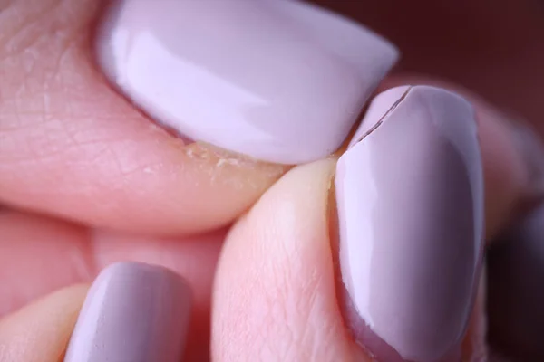 Close-up de dedos femininos com manicure lilás estragado em unhas — Fotografia de Stock