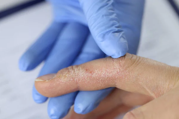 Kesztyű orvos vizsgálja pikkelyes bőr kéz. — Stock Fotó