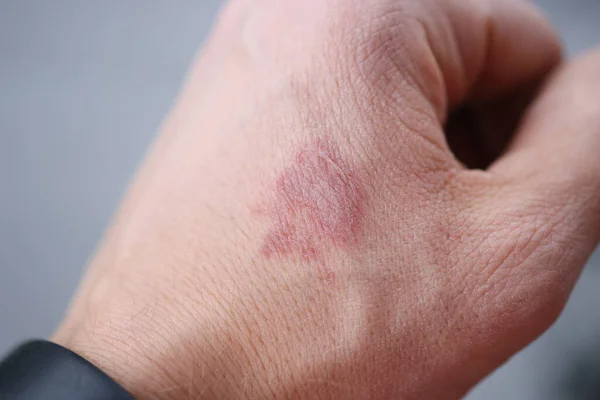 Detailní záběr skvrny od popálenin na mužské ruce — Stock fotografie