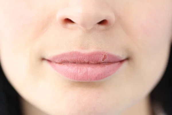 El primer plano de las úlceras por herpes en los labios de la mujer joven — Foto de Stock