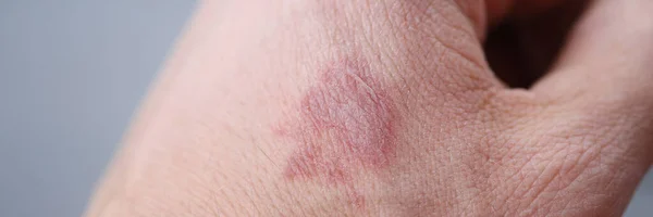 Zbliżenie plamy oparzeniowej na dłoni człowieka — Zdjęcie stockowe