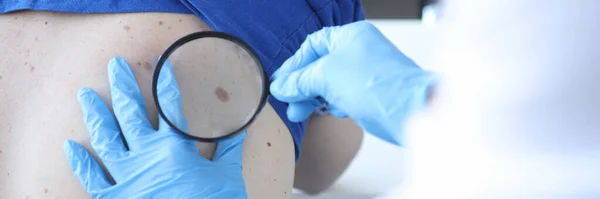 Dokter onderzoekt gepigmenteerde nevus van de patiënt met vergrootglas close-up — Stockfoto