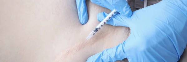 Gloved doctor injects the keloid scar closeup — Stock Photo, Image