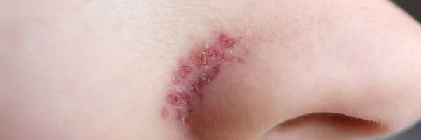 Close-up de erupção vermelha inflamada no nariz das mulheres — Fotografia de Stock