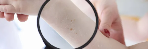 Doctor examines hand with moles through magnifying glass — Stock Fotó