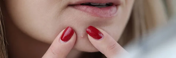 Young woman squeezing out pimple with her hands closeup
