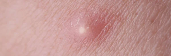 Borbulha com descarga purulenta no close-up da pele — Fotografia de Stock