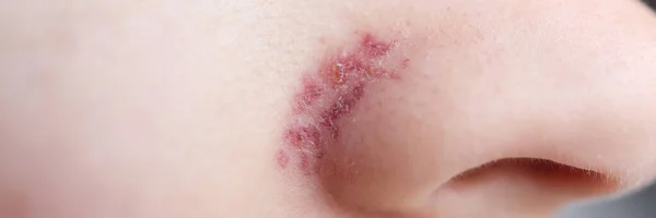 On wings of nose, skin after removal of vascular mesh — Stock Photo, Image