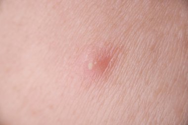 Yüzünde beyaz iltihap sivilcesi var.