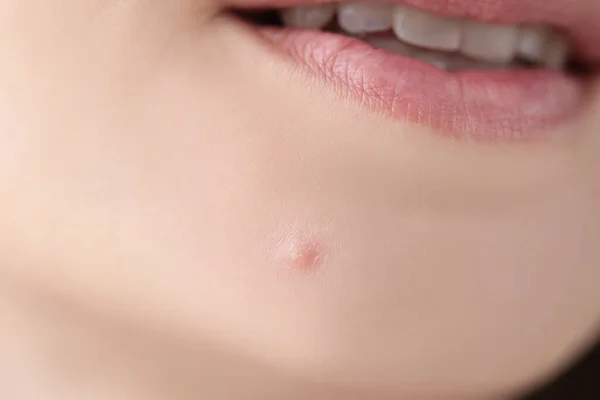 Closeup of white pimple on chin skin of young woman — Stock Photo, Image