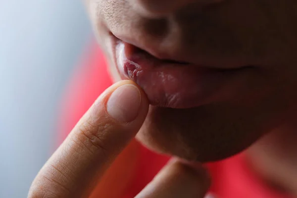 Человек, держащий сломанную губу с гематомой рукой крупным планом — стоковое фото