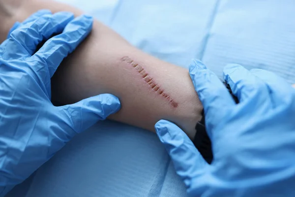 Chirurg in medizinischen Schutzhandschuhen untersucht Narben an der Hand des Patienten — Stockfoto