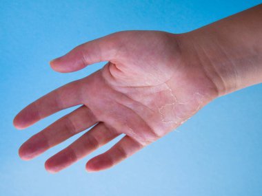 Sulu mavi bir arka planda kadın avucu. Derinin bir kısmı soyulmuş ve soyulmaya başlamış. Sağlık sorunu: vitamin eksikliği. Cilt bakımı kavramı.