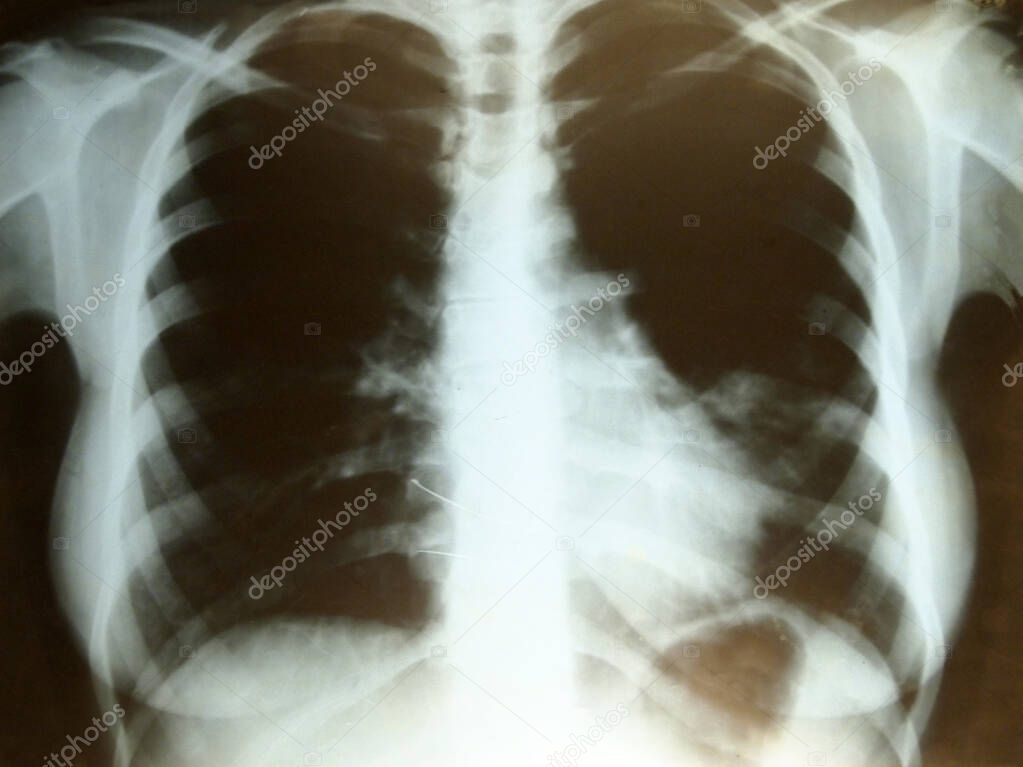 Abstract blurred view of blurred x-ray of human lungs.