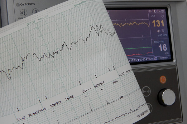 Графики фиксирования и печати сердечного ритма
