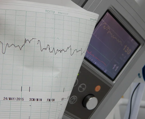 Fijación del cardiógrafo e impresión de gráficos de frecuencia cardíaca —  Fotos de Stock