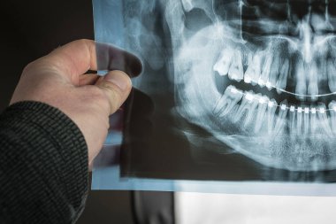 Dişlerinde diş teli olan bir insanın X-ray diş taramasını tutan eli görülüyor, hareket eden diş izleri var, bükülmüş kökler gibi. İki üst diş kayıp..