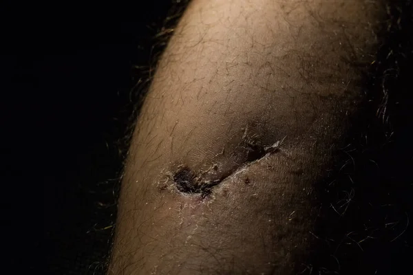 Detail of a healing wound and torn muscle on a leg. Visible scar, dried skin, stitch marks and shaven hair. Dramatical lighting from the left side.