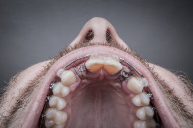 Macro shot of a two installed implants in a human mouth. Closed healing implant on left with visible stitches and open healing implant on right surrounded by gums and stitches. Copy space on top clipart