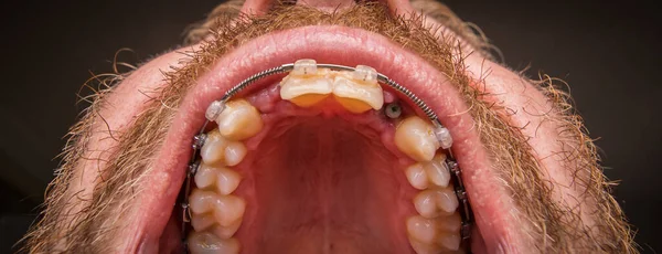 Macro shot of a two installed implants in a human mouth. Closed healing implant on left and open healing implant on on right surrounded by gums and healing tissue.  Visible nut of an implant in jaw