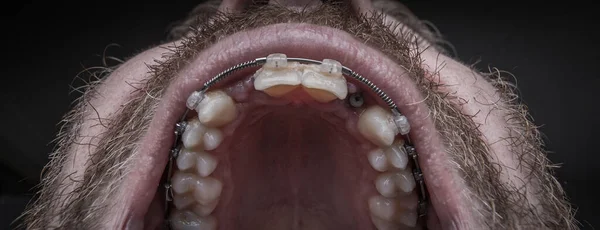 Macro shot of a two installed implants in a human mouth. Closed healing implant on left and open healing implant on on right surrounded by gums and healing tissue.  Visible nut of an implant in jaw