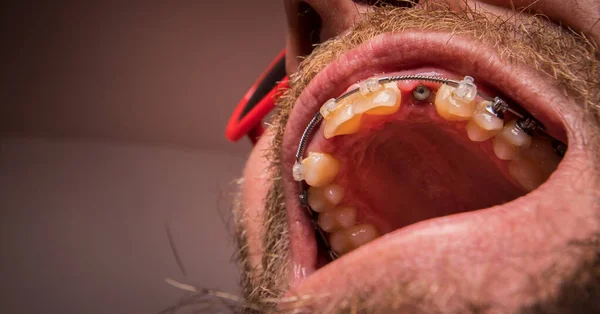 Macro Shot Two Installed Implants Human Mouth Closed Healing Implant — Stock Photo, Image