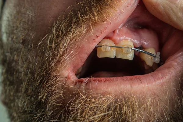 Widoczny Implant Zęba Męskich Dziąsłach Otoczony Ustami Zaschniętą Krwią Brodą — Zdjęcie stockowe