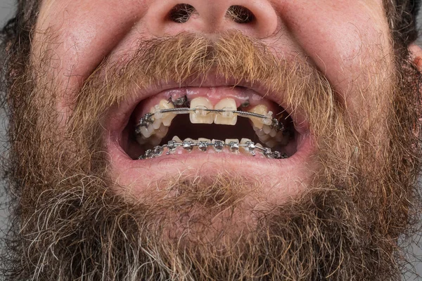 Üst Çeneye Iki Diş Implantı Her Iki Diş Sırasına Metal — Stok fotoğraf