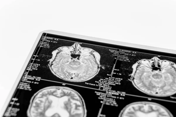 Masada MRI kafa taraması izleri var.