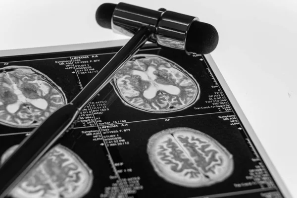 MRI kafa taraması masada nörolojik çekiçle yapılır.