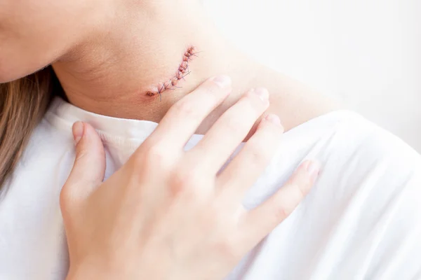 Scar mole on woman's neck — Stock Photo, Image