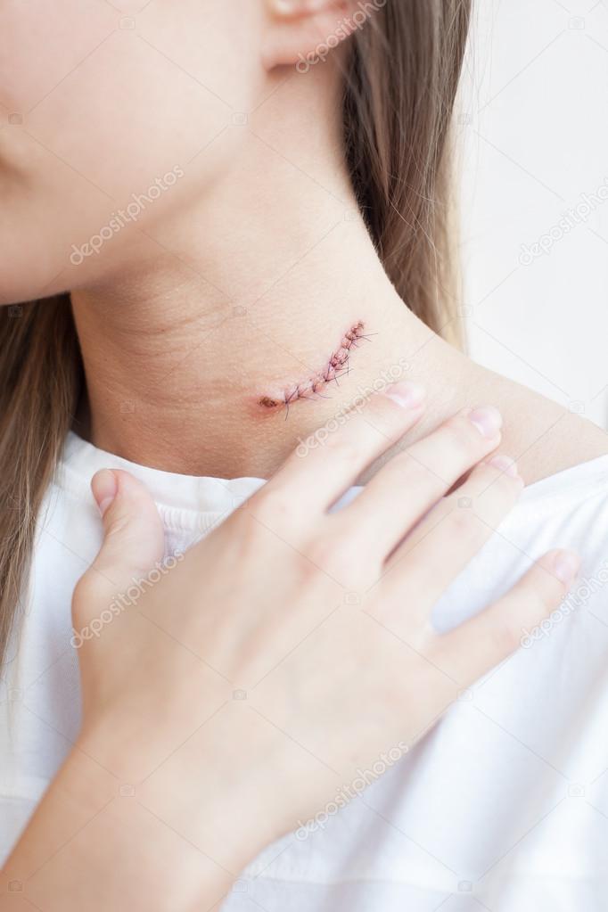 Scar mole on woman's neck - Stock Photo, Image. 