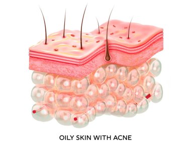 Sivilceli yağlı cilt. Cilt katmanlarının mikro katmanlarının 3 boyutlu çizimi. Tıbbi ve eğitici resimler izole edilmiş.