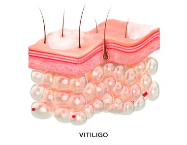 Gerçekçi insan enine kesitli deri yapısı vitiligo ile. 3D tıbbi cilt illüstrasyonu