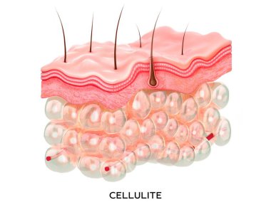 Selülit deri kesitleri. Üç boyutlu illüstrasyon tıbbi konsepti. Derinin içindeki yağ hücreleri