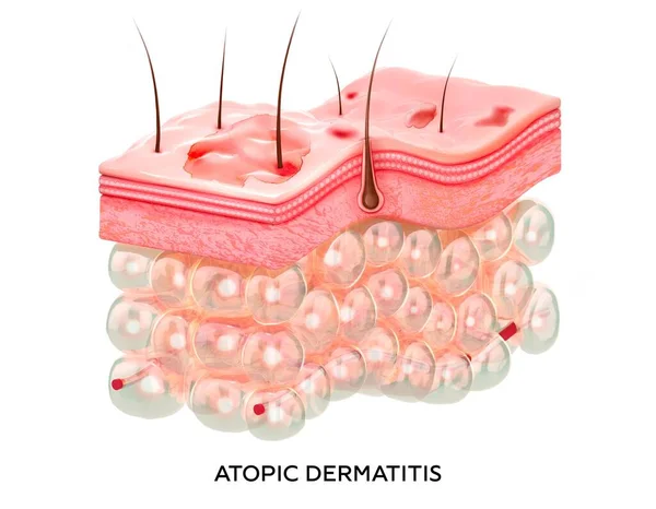 Eccema. Ilustración 3d de la sección transversal de las capas de piel con dermatitis atópica. Piel dañada. — Foto de Stock