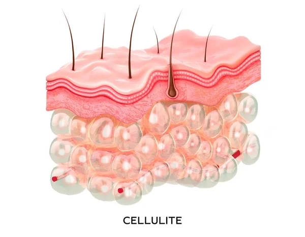 Strati di cellulite a sezione trasversale. Illustrazione 3d concetto medico. Cellule grasse all'interno della pelle — Foto Stock