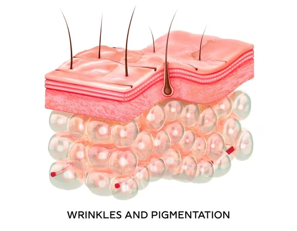 Piel con arrugas y manchas de la edad. 3d ilustración de la estructura de las capas de la piel microestructura. imágenes médicas y educativas aisladas —  Fotos de Stock