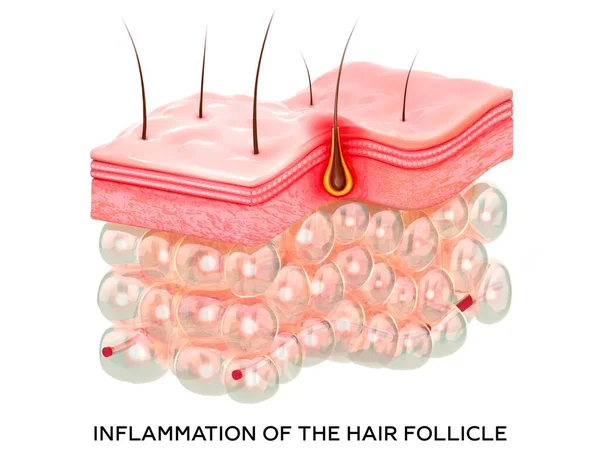 INFLAMACIÓN DEL FOLÍCULO DEL PELO 3D representación realista 3d ilustración de las capas de la piel. — Foto de Stock