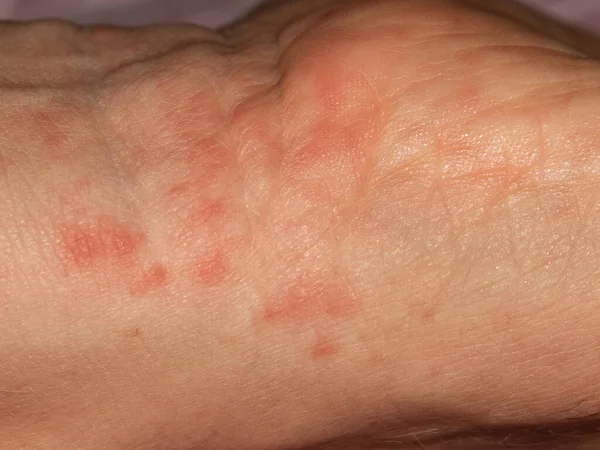 Инфекция Скарлатины Заразное Заболевание — стоковое фото