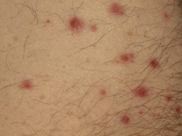 Болезнь Скарлатины Инфекционная Инфекция — стоковое фото