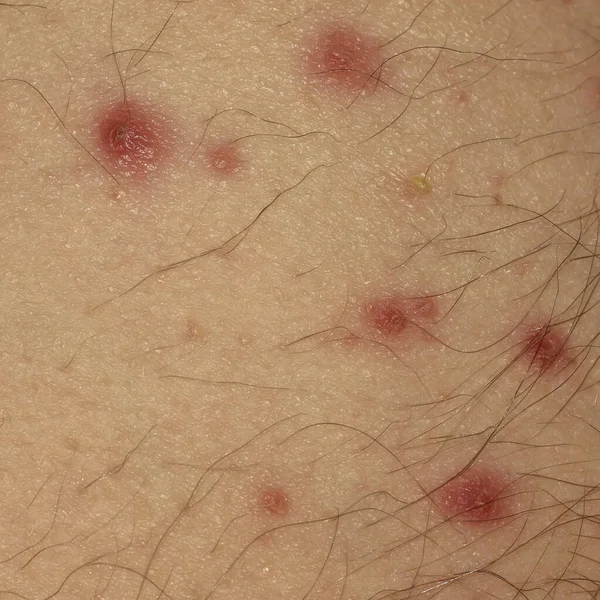 Infezione Batterica Contagiosa Sull Uomo Adulto Caucasico — Foto Stock