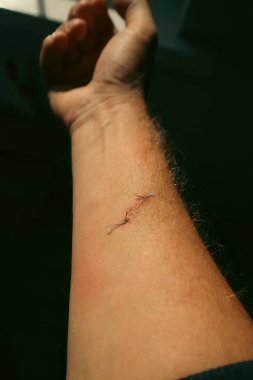 Bir adamın kolundaki derin bir yaranın yakın çekimi, taze mor cerrahi dikişlerle kapatılmış. Yaranın etrafındaki deri iyileşiyor. Travma, ameliyat ve tıbbi iyileşme kavramı.