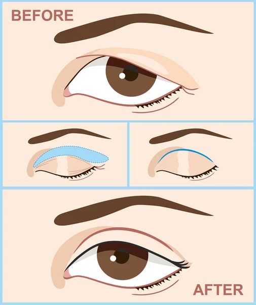 Augenlidblepharoplastik. Vor und nach der doppelten Augenlidoperation bei Frauen. Vektorillustration mit doppelter Augenlidoperation. Infografiken mit Ikonen der plastischen Chirurgie. — Stockvektor