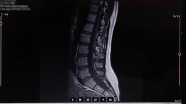 Doktor bel omurgasının MR taramasını inceleyerek geniş tabanlı L5-S1 disk çıkıntısını vurguluyor. Bu sahne tıp eğitimi, omurilik sağlığı farkındalığı ve teşhis sunumları için idealdir.