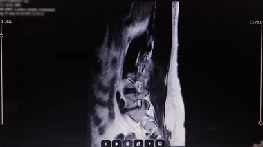 Bel omurgasında ön ve arka eklemli bipolar disk fıtığı, tıp eğitimi için ideal, radyoloji referansı, teşhis ve sağlık sigortası içeriği..