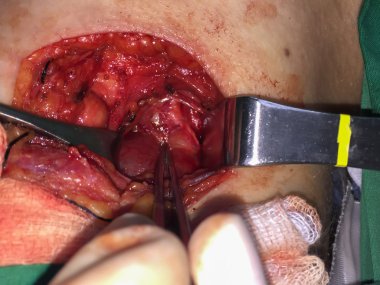 Boyun cerrahi işlem donanımları ile