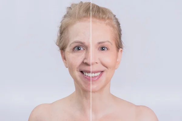Before and after sking treatment — Stock Photo, Image