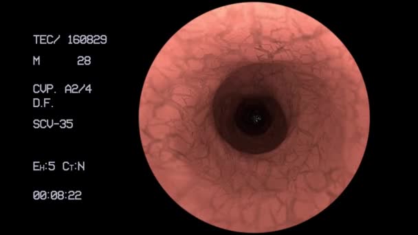 Endoscópio Câmera Médica Intestino Intestino Cólon Médico Endoscopia Cirurgia — Vídeo de Stock